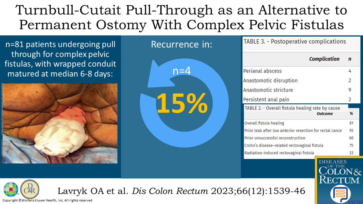 DCRjournal (@dcrjournal) on Twitter photo #DCRJournal visual abstract | Turnbull-Cutait Pull-Through Procedure Is an Alternative to Permanent Ostomy in Patients With Complex Pelvic Fistulas: bit.ly/40CYo3g
<a href="/ScottRSteeleMD/">Scott R. Steele</a> <a href="/drtracyhull/">Tracy Hull</a>
<a href="/KyleCologne/">Kyle Cologne</a> <a href="/dubaicolorectal/">Maher A. Abbas, MD, FACS, FASCRS, FPSCRS-Honorary</a> <a href="/SamAtallahMD/">Sam Atallah, MD</a> <a href="/debby_keller/">Debby Keller, MD</a> <a href="/SeanLangenfeld/">Sean Langenfeld</a> #DCRJournal visual abstract | Turnbull-Cutait Pull-Through Procedure Is an Alternative to Permanent Ostomy in Patients With Complex Pelvic Fistulas: bit.ly/40CYo3g
<a href="/ScottRSteeleMD/">Scott R. Steele</a> <a href="/drtracyhull/">Tracy Hull</a>
<a href="/KyleCologne/">Kyle Cologne</a> <a href="/dubaicolorectal/">Maher A. Abbas, MD, FACS, FASCRS, FPSCRS-Honorary</a> <a href="/SamAtallahMD/">Sam Atallah, MD</a> <a href="/debby_keller/">Debby Keller, MD</a> <a href="/SeanLangenfeld/">Sean Langenfeld</a>