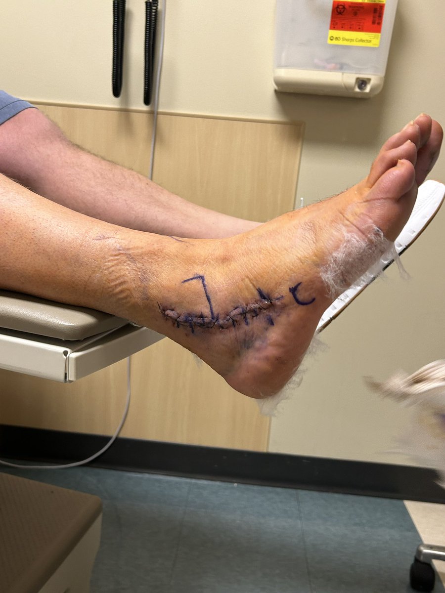 r_saunders15's tweet photo. 2 weeks post op. Stitches out, 4 more weeks non weight bearing then 6 weeks of PT. https://t.co/UoT7wwvI7T