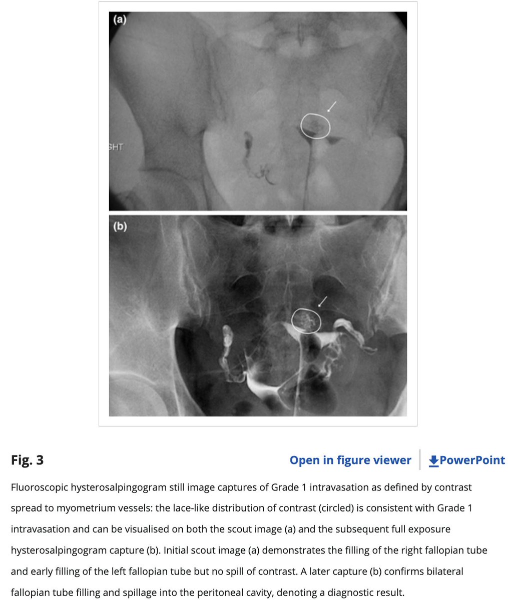 An example of Grade 1 intravasation from the recent #openaccess article by @EmmelineLee and @ciyuechia :