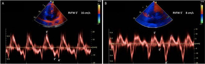 RutgersNJMS_POCUS (@rutgerspocus) on Twitter photo The right ventricle (RV) contracts mostly (70%) in the longitudinal direction.
Using tissue Doppler (i.e. hitting the TDI and then PWD buttons), S' represents the velocity of the lateral tricuspid annulus during systole.
S’ < 9.5 cm/s suggests RV systolic dysfunction. The right ventricle (RV) contracts mostly (70%) in the longitudinal direction.
Using tissue Doppler (i.e. hitting the TDI and then PWD buttons), S' represents the velocity of the lateral tricuspid annulus during systole.
S’ < 9.5 cm/s suggests RV systolic dysfunction.