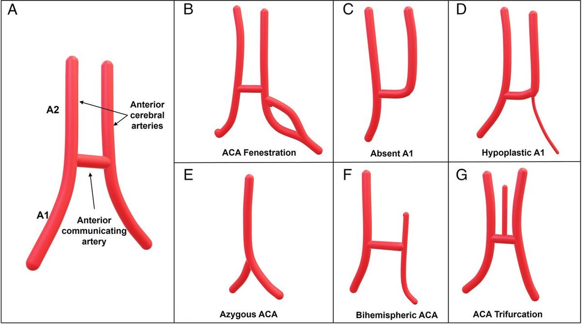Anterior cerebral artery (ACA) anatomy and anomalies. (A) Normal ...