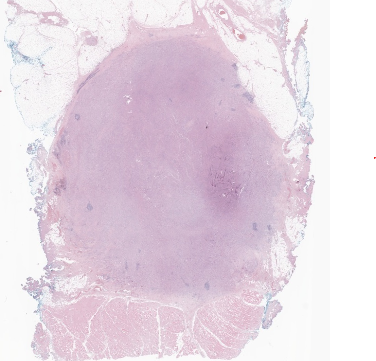 EricMadPatho's tweet photo. 38/F right flank 2cm mass with paresthesia upon touch. History of liposuction through that area 2 years ago. Gross: yellow, finely granular. Perineural infiltration of granular cells, positive for S-100. Granular cell tumor. #BSTPath #PathX #pathresidents #Pathtwitter https://t.co/1Po08kRBb2