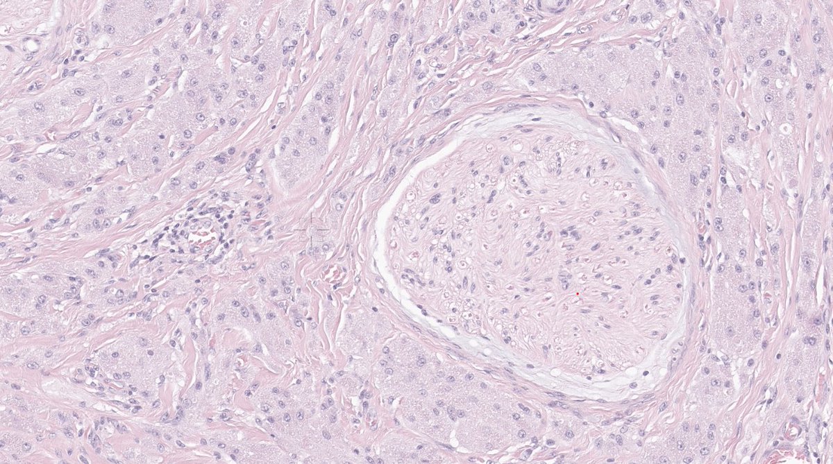 EricMadPatho's tweet photo. 38/F right flank 2cm mass with paresthesia upon touch. History of liposuction through that area 2 years ago. Gross: yellow, finely granular. Perineural infiltration of granular cells, positive for S-100. Granular cell tumor. #BSTPath #PathX #pathresidents #Pathtwitter https://t.co/1Po08kRBb2