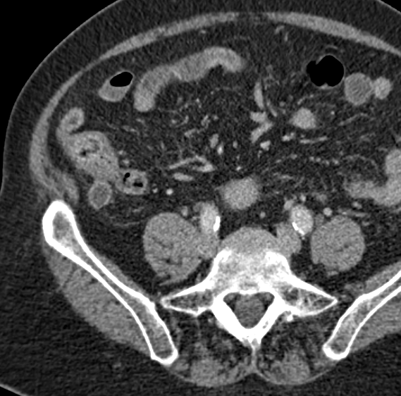 theimageologist's tweet photo. Low-grade Appendiceal Mucinous Neoplasm
#LAMN #radiology #appendix #cancer #malignancy #mucocele #mucinousneoplasm #GI #oncology #surgery #gensurg #generalsurgery #CT #raded #meded #medicine #medtwitter #radtwitter # https://t.co/FgJlC5IquX