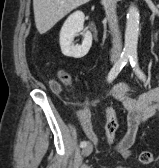 theimageologist's tweet photo. Low-grade Appendiceal Mucinous Neoplasm
#LAMN #radiology #appendix #cancer #malignancy #mucocele #mucinousneoplasm #GI #oncology #surgery #gensurg #generalsurgery #CT #raded #meded #medicine #medtwitter #radtwitter # https://t.co/FgJlC5IquX