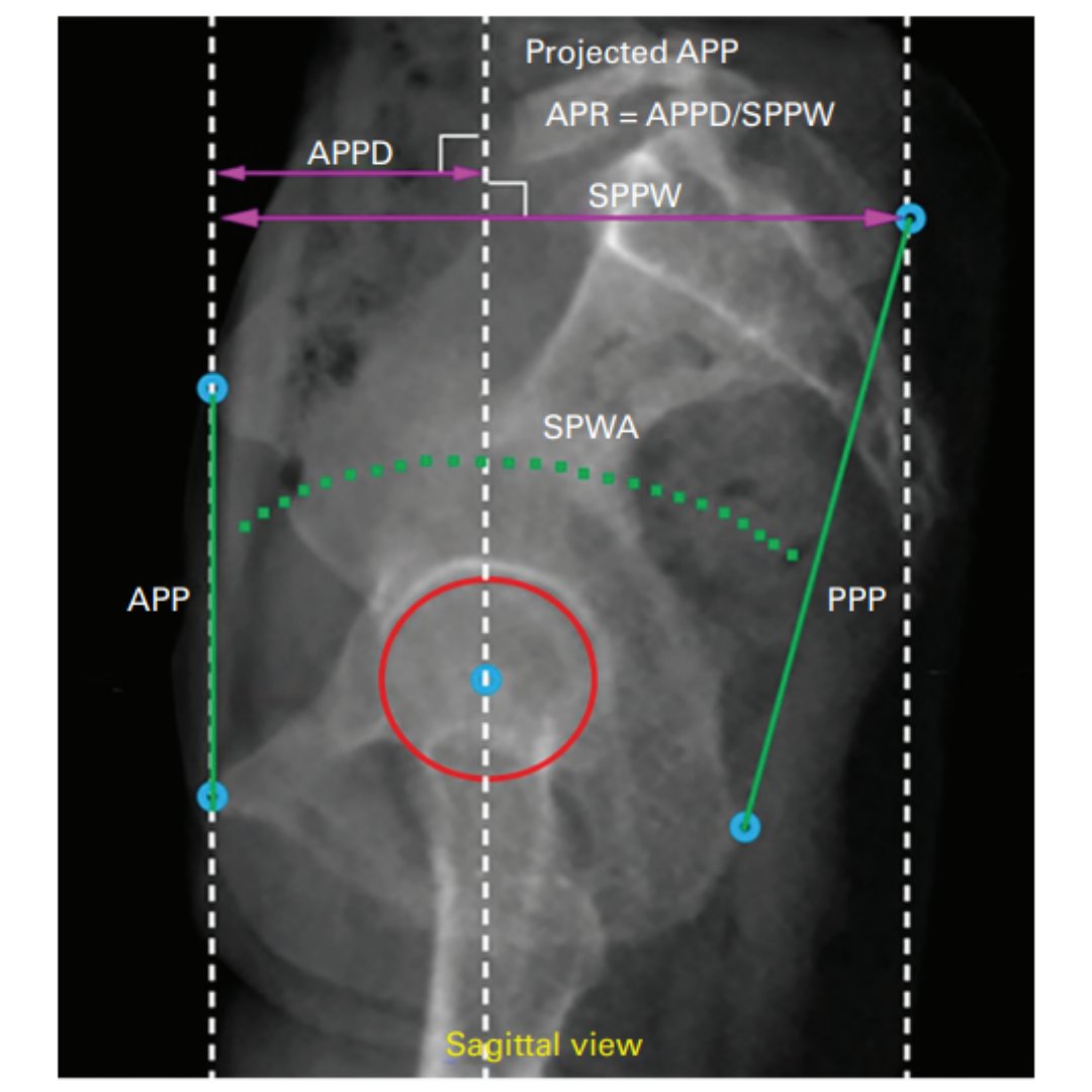 BoneJointJ's tweet image. Does acetabular retroversion represent a structural anatomical abnormality of the pelvis, or is it a functional phenomenon of pelvic positioning in the sagittal plane?

#Hip #Radiograph #BJJ @ortho_pods

ow.ly/1JGA50QvPCF