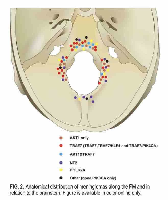 Journal of Neurosurgery (@thejns) on Twitter photo #OnlineFirst: Genetic characterization and mutational profiling of foramen magnum meningiomas: a multi-institutional study. 
thejns.org/view/journals/…. #OnlineFirst: Genetic characterization and mutational profiling of foramen magnum meningiomas: a multi-institutional study. 
thejns.org/view/journals/….