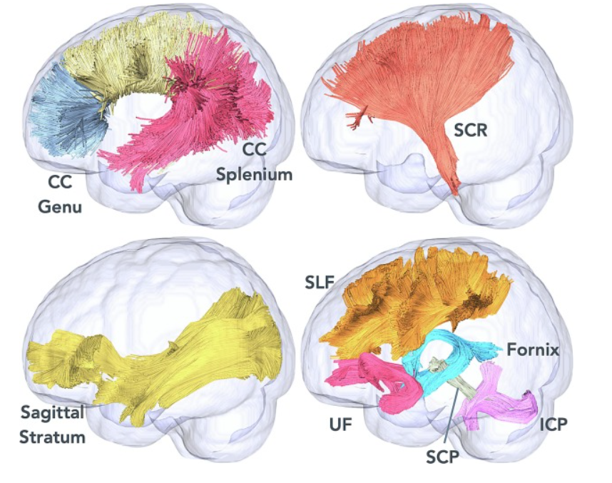 Prenatal alcohol exposure (PAE) can cause alterations in brain development, especially during early life. Drs. Katherine Narr, Roger Woods, and Shantanu Joshi use neuroimaging to examine how white matter changes may occur due to PAE. #NeuroTwitter pubmed.ncbi.nlm.nih.gov/38309186/