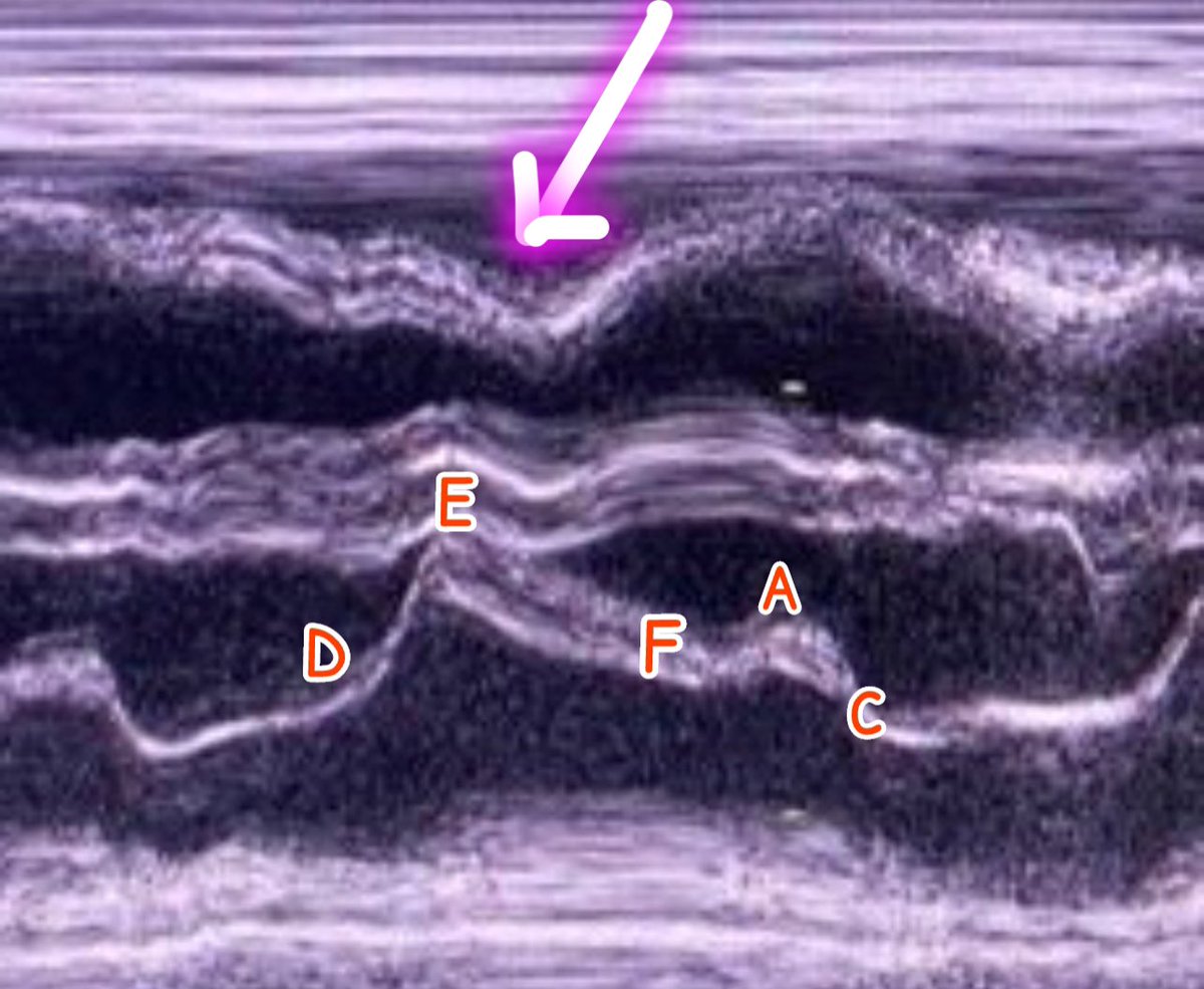 #POCUS #MedTwitter #FOAMed 

1/

Cardiac tamponade: M -mode Echocardiography 

RVOT dip = RV diastolic collapse 

> Highly specific 👇