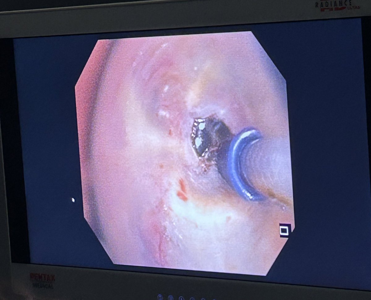 Hoy hemos tenido otro caso de reducción de volumen en enfisema pulmonar mediante vapor por cisuras incompletas. Hemos tratado dos segmentos RB1 y RB3 🫁