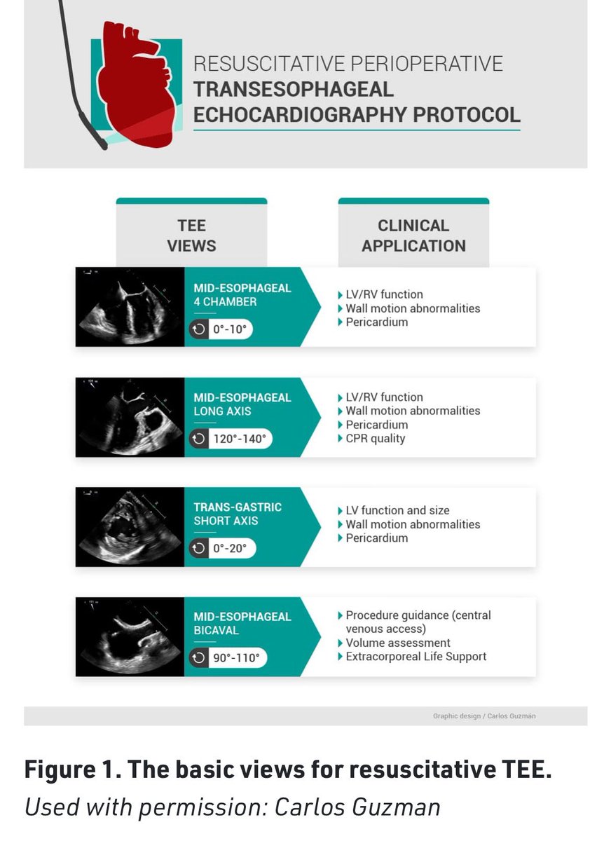 @ASRA_Society #POCUS Spotlight: Resuscitative Perioperative TEE @UofTanesthesia @JMorenoGarijo @lgiron86 @ElmariNeethling #GrabTheProbe #ResusTEE @ResusTEEproject @CASUpdate @CAS_CVT @ASE360 @SCCM_Anesth @ON_Anesthesia asra.com/guidelines-art…