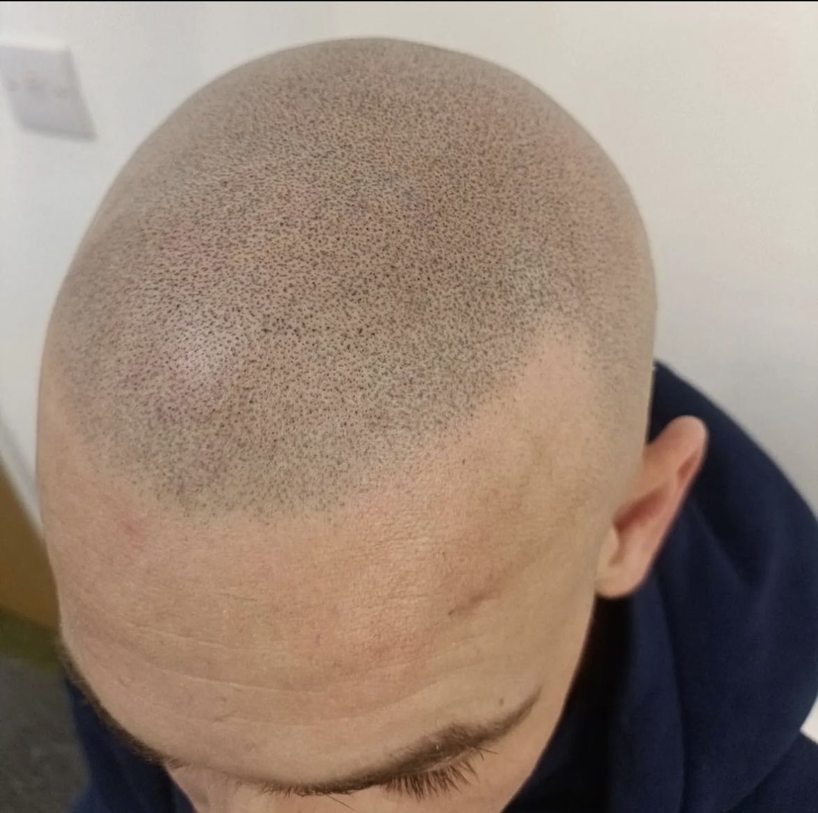 scalprenovation's tweet image. A few recent snippets 

#SMP
#SCALPMICROPIGMENTATION
#SCALPPIGMENTATION
#SCLAPRENOVATION
#UKBARBER
#MENSHAIR
#HAIRLOSS
#HAIRLOSSTREATMENT 
#HAIRLOSSISTOSS
#MALEPATTERNBALDNESS
#ALOPECIA 
#HAIRTATTOO
#HAIRLOSSTATTOO