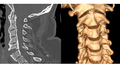 The top 8 #AI models in the @RSNA Cervical Spine Fracture Challenge doi.org/10.1148/ryai.2… @lmprevedello @BFlanksteak @OSURadiology #SpineFracture #trauma #MachineLearning