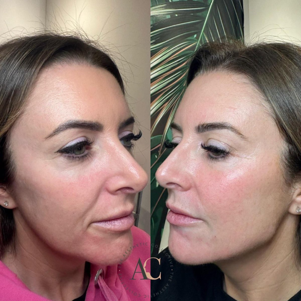 Chin reshape before & after from the GOATS @theaestheticcollectiveuk #chinfiller #lipfiller #cheekfiller #jawlinefiller #dermalfillers #fillers #aesthetics #botox #aestheticsmiltonkeynes