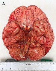 almagoch's tweet photo. El @NEJM publicó ayer el seguimiento de 13 pacientes con #meningitis por Fusarium solani, un 🍄🟫 que adquirieron durante una anestesia epidural en #Matamoros, Tamaulipas. 9 ☠️ x un🍄🟫 angioinvasor del sistema vertebrobasilar. Los supervivientes están recibiendo #fosmanogepix. https://t.co/3nUdFUq7p5