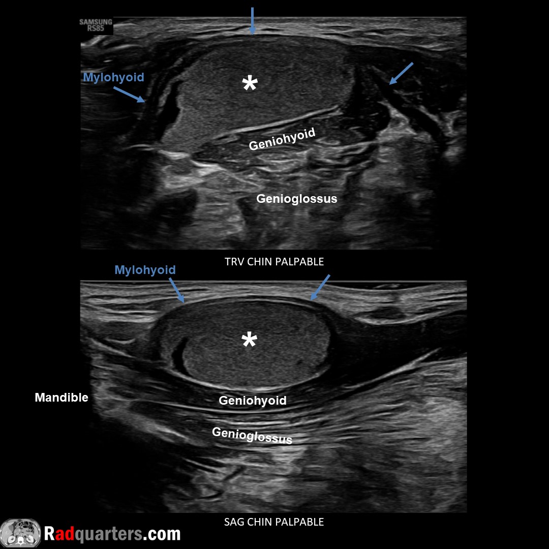 Sublingual dermoid cyst. Rare, benign, squamous epithelial lining & contains skin appendages. Sublingual space bounded medially by genioglossus/geniohyoid muscles, inferolaterally by mylohyoid. Watch📽️ to learn more: bit.ly/subderm @BostonImaging @SamsungHealth #FOAMrad