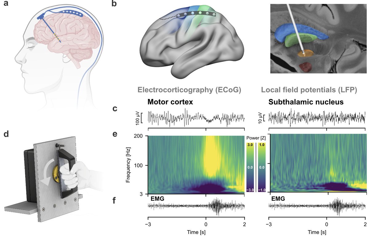 Julian Neumann (@neumann_wj) on Twitter photo Preprint 🚨Spearheaded by @rm_koehler and co-lead by <a href="/johndylanhaynes/">John-Dylan Haynes</a>. We trained invasive brain signal decoders to elucidate shared therapeutic effects of #dopamine and deep brain stimulation for self-initiated actions in #Parkinson's disease. doi.org/10.1101/2023.1…
1/n🧵 Preprint 🚨Spearheaded by @rm_koehler and co-lead by <a href="/johndylanhaynes/">John-Dylan Haynes</a>. We trained invasive brain signal decoders to elucidate shared therapeutic effects of #dopamine and deep brain stimulation for self-initiated actions in #Parkinson's disease. doi.org/10.1101/2023.1…
1/n🧵