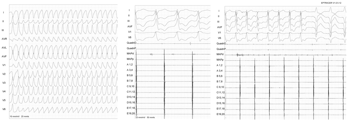 Chagas VT finished by a slow sub aortic VT. w/@luizrleite @Fabiobotelho_ @AndreAssisCarmo @crpisani @Codietrich @CarinaHardy4