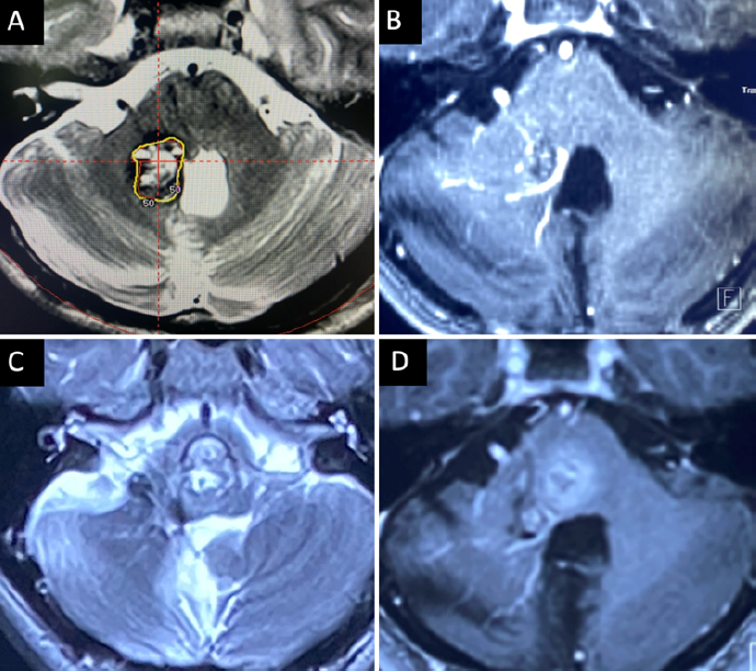 In JNS Peds, a new study on SRS for cerebral cavernous malformations in pediatric patients. The work was led by my team at UVA.