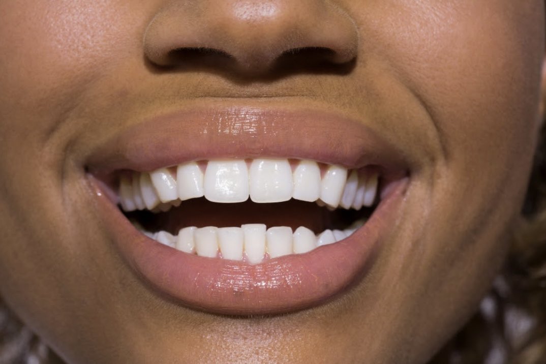 zizelle_'s tweet photo. It’s #Worldtoothacheday
Here are 4 key facts about oral health.
- Oral disease affects 3.9 billion people worldwide with untreated tooth decay.
- Globally, between 60-90% of school children and nearly 100% of adults have tooth decay.
- Severe gum disease, which may result in tooth loss affect 15-20% of middle aged adults.
- Globally, about 30% of people aged 65-74 have no natural teeth.
It’s important to observe better oral hygiene to protect our mouths and body in general.
- Brush 2 times daily
- Floss regularly
- Use a mouthwash
- Regular visits to the dentist
- Reduce sugar intake.
Everything we eat has an impact on our teeth and not taking care of it leads to toothache and oral diseases.
Take better care today!