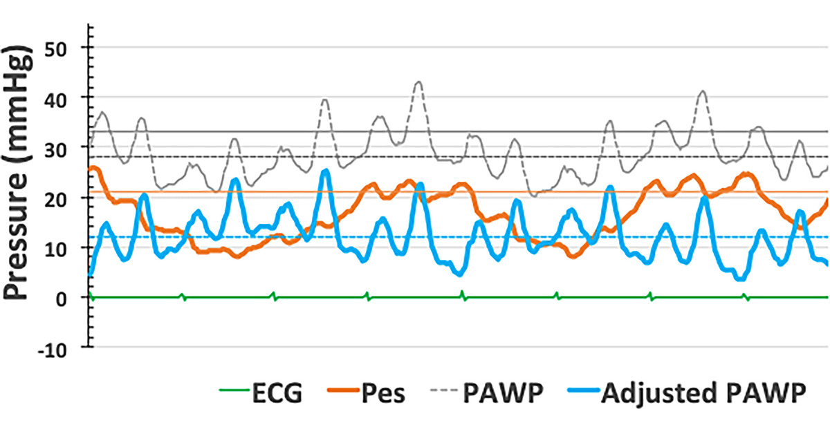 ATSBlueEditor's tweet photo. Pulmonary Artery Wedge Pressure in the Diagnosis of Pulmonary Arterial Hypertension

🔓 Open Access
🔗 https://t.co/yiPvYj8jfU https://t.co/VJrSOxWGSC