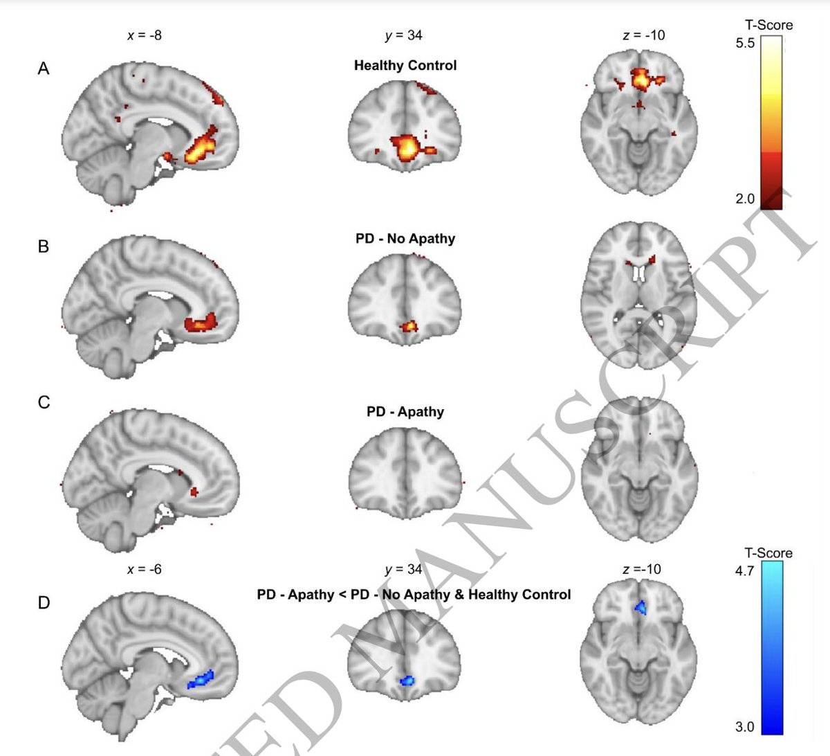 MichaelOkun's tweet photo. Does the presence of 'apathy' in Parkinson's disease affect how you make decisions? You bet it does. Gilmour and colleagues @Brain1878 use a behavioral task plus advanced imaging to show us how the brain works when you have apathy and Parkinson's disease.
Key points:
- Apathy is a common and disabling in Parkinson's.
- Apathy is associated w/ a reduction in goal-directed behavior. 
- We think about prefrontal cortical regions and brainstem being affected,
- We think beyond dopamine and include serotonin and norepi in the discussion of apathy.
- Your brain must encode the value of decisions.
- Your brain functions to either 1- explore alternative courses of action or 2- to persist in a strategy. 
My take: Apathy is more common than depression in Parkinson's and it has a big impact on quality of life. The authors show convincingly that apathy is associated with 'an impairment in value-based learning.' The apathy group in their study made decisions that were 'indifferent' to a learned value of available options. The reduction in the imaging signal in ventromedial prefrontal cortex was convincing.  Thalamo-cortical networks and enhanced thalamic signal in their study seemed to predict individual apathy severity. The authors posit that the use of this network was the attempt to compensate for the apathy. When you treat a person with apathy remember that the apathy will affect how a person encodes the value of decisions.
https://t.co/m3fSfHEbaT #Parkinsons #apathy
