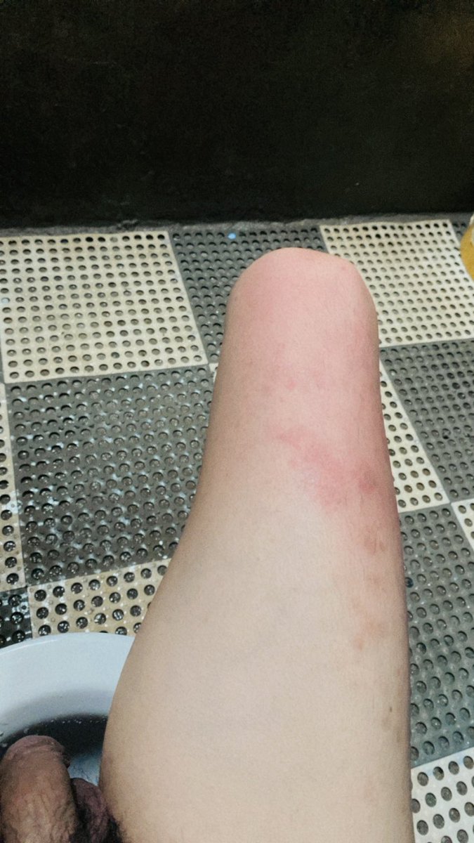 Grabe sunburn!