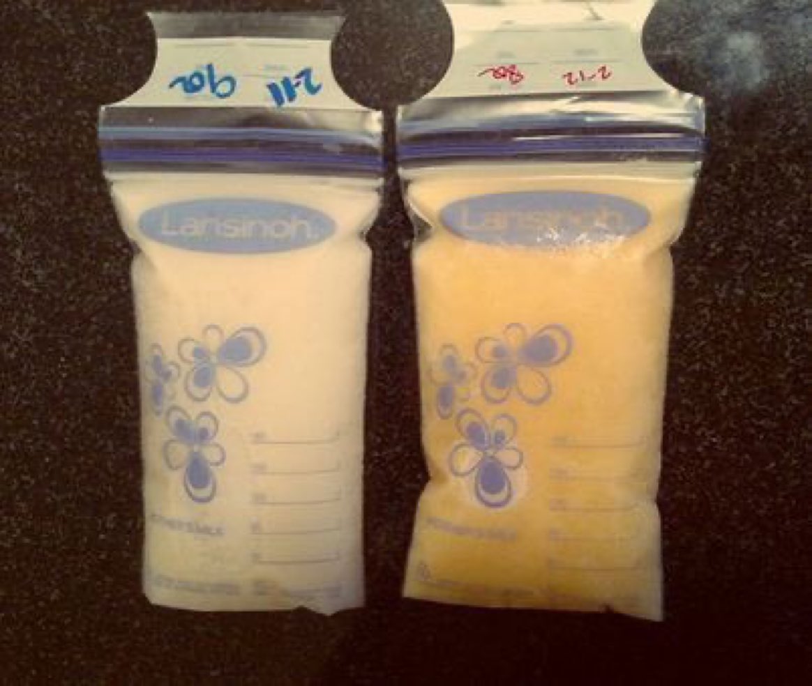 sciencegirl's tweet photo. Look at this picture, here a mother noticed her milk visibly changed overnight to meet the demands of her baby who was unwell at the time 

Those signals are communicated to the mother by saliva from her baby, the mother may even be unaware of her baby’s health status yet levels of white blood cells in milk are boosted. 

Research shows compositions of lactoferrin which is an immune molecule, which carries out protective functions like piercing the walls of harmful bacteria, are also found to be increased in the weeks prior to and following an infant's illness. 

This milk is awesome in its complexity and the way it constantly changes and is tailored  1/🧵

📸Mallory Smothers