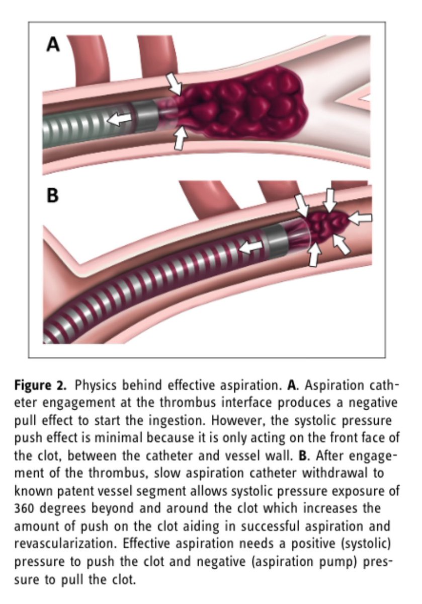 Standardized approach to direct first pass aspiration technique for endovascular thrombectomy: Description and initial experience with CANADAPT journals.sagepub.com/doi/full/10.11…