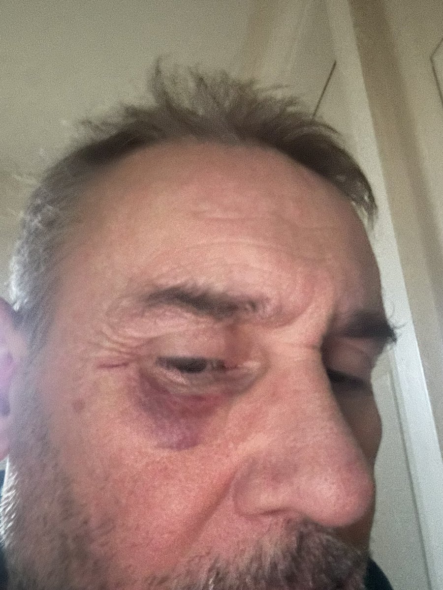 DPH180's tweet photo. Nice little bruise https://t.co/TQ62ST85QM