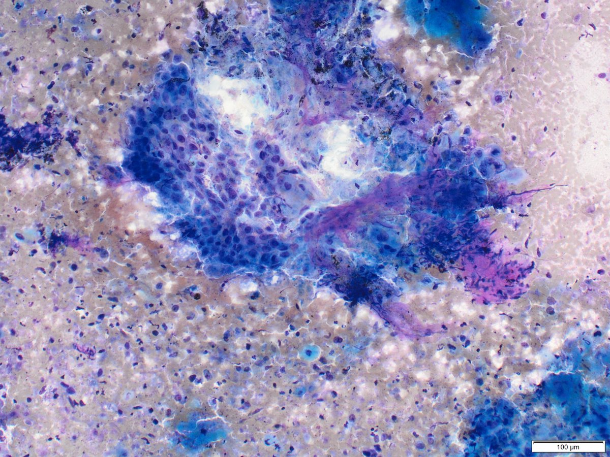 Spot diagnosis in a mediastinal lymph node for this #FNAFriday.