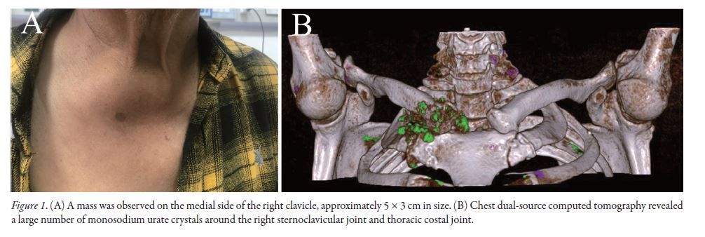 jrheum's tweet image. Images in Rheumatology

Thoracic Clavicular Gout

📰 doi.org/10.3899/jrheum…

#thoracic #gout