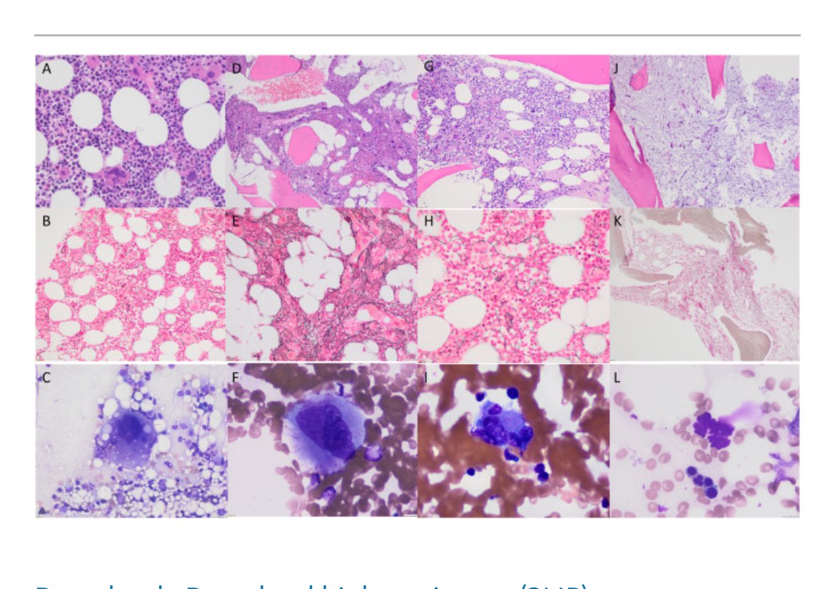 Happy to share our review on #MPNsm A true clinical & pathological approach written w/ my friends @bose_prithviraj @pankitvachhani See if you can guess the Dx from image before looking at the paper 😉 Free full text: authors.elsevier.com/c/1iZqS7fNb0Dz…