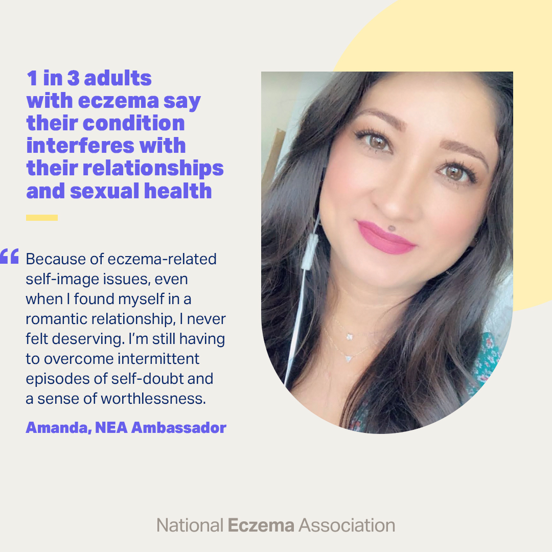 nationaleczema's tweet photo. Amanda knows that eczema can affect not only your relationship with yourself, but also your relationship with others.
She became a NEA ambassador to remind people with eczema that they are worthy of love 💓
Join Amanda and become a #NEAAmbassador today! https://t.co/9mUMYjRsjS https://t.co/9FvtkHnU7q