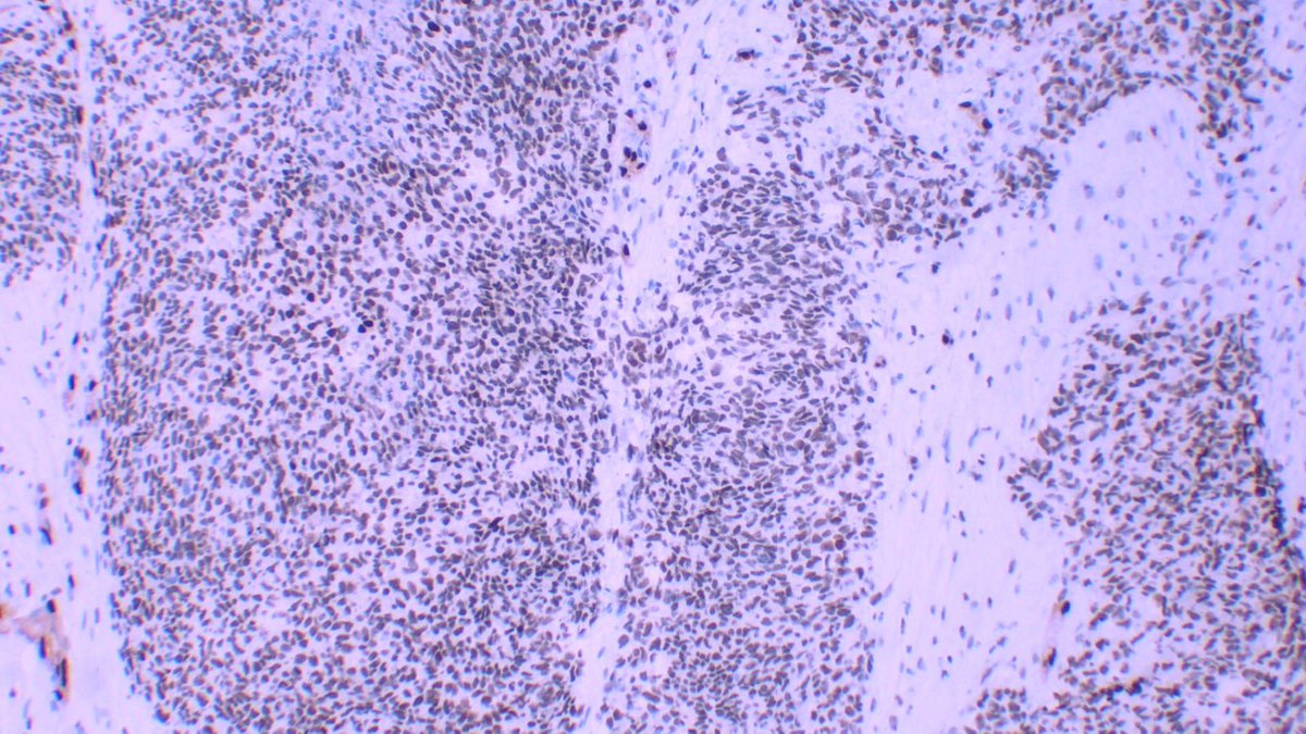 7 year-old girl with a thoracic wall mass There was focal positivity for CD99 (not shown) and positivity for WT1 (3rd image) and ERG (4th image) What could this be? #bstpath #pedpath #PathTwitter