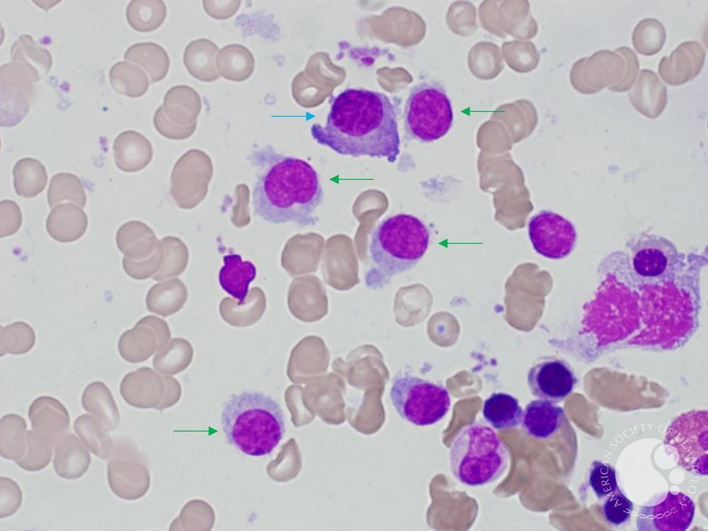 Hairy Cell Leukaemia and Multiple Myeloma 1 | ASH Image Bank | American Society of Hematology imagebank.hematology.org/image/64900/ha… #ASHImageBank