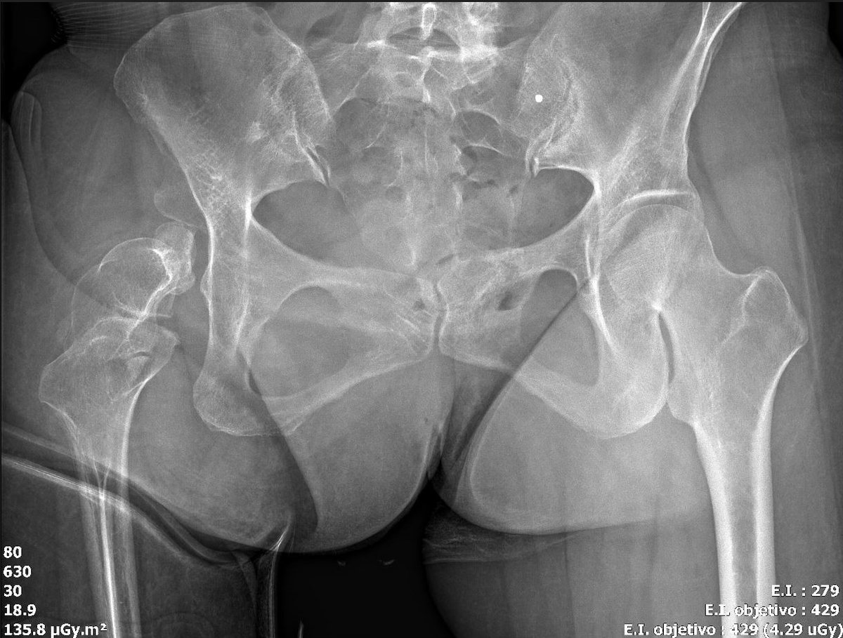 pepelermarx's tweet photo. Severe case of proximal femoral focal deficiency (rare congenital anomaly) + peroneal hemimelia + absence of patella. Thanks to @akassarjian for organizing the @MadridBoneClub ! 🦴🥁🦴🥁#mskrad #Orthopedics #BoneClub @themskarchive @JM_Zulueta_O @drwillyjara https://t.co/cHU3lb9Afw
