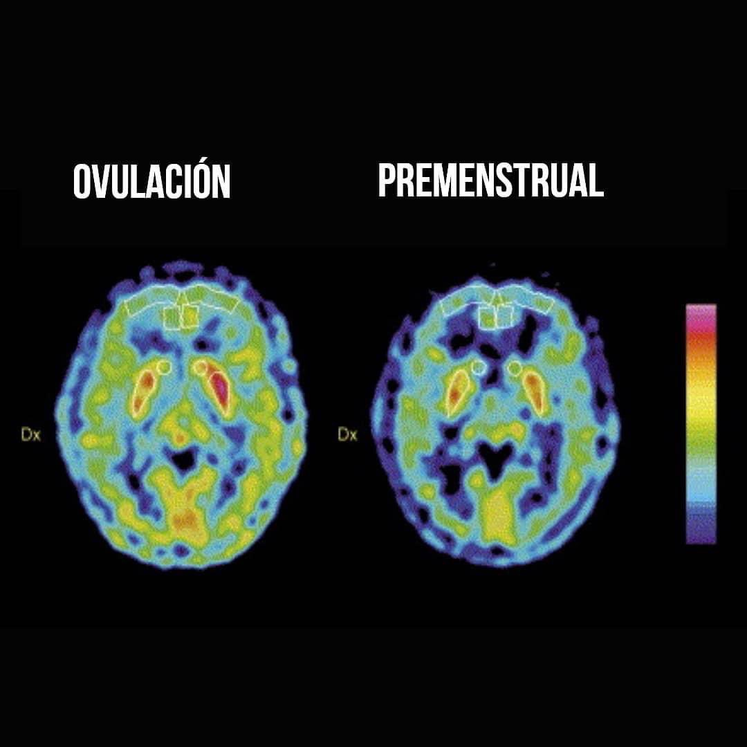 InformaCosmos's tweet photo. ¿Lo sabías?  El ciclo menstrual determina aspectos conductuales determinantes en el cerebro femenino. 

Durante la ovulación, donde existe una alta concentración de estrogenos en el torrente sanguíneo, el cerebro femenino experimenta un efecto antidepresivo natural. 

Luego, previo a la siguiente menstruación, la deficiencia estrogenica induce una clara orientación depresiva. De hecho, cuando se convierte en problema, recibe el nombre de trastorno disfórico premenstrual.