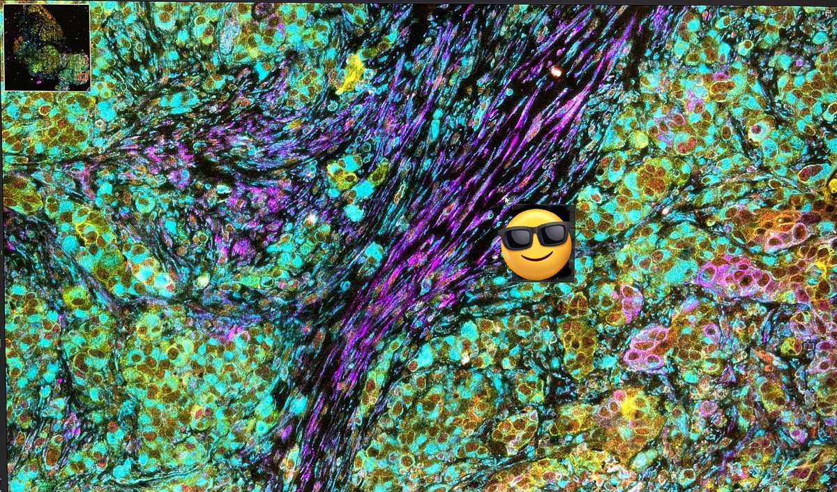 Have you ever seen a nicer #highplexIF?
This #WorkOfArt is a human #pancreaticcancer sample in 29 colors (showing less)

The ongoing study is lead by the amazing <a href="/JanuszFranco/">Janusz Franco, MD PhD</a> from <a href="/FoxChaseCancer/">Fox Chase Cancer Center</a> <a href="/templemedschool/">Temple Med School</a> <a href="/CukiermanLab/">CukiermanLab</a> <a href="/FCCCGreenberg/">Greenberg Pancreatic Cancer Institute</a> 

#FluorescenceFriday

😎=intentional