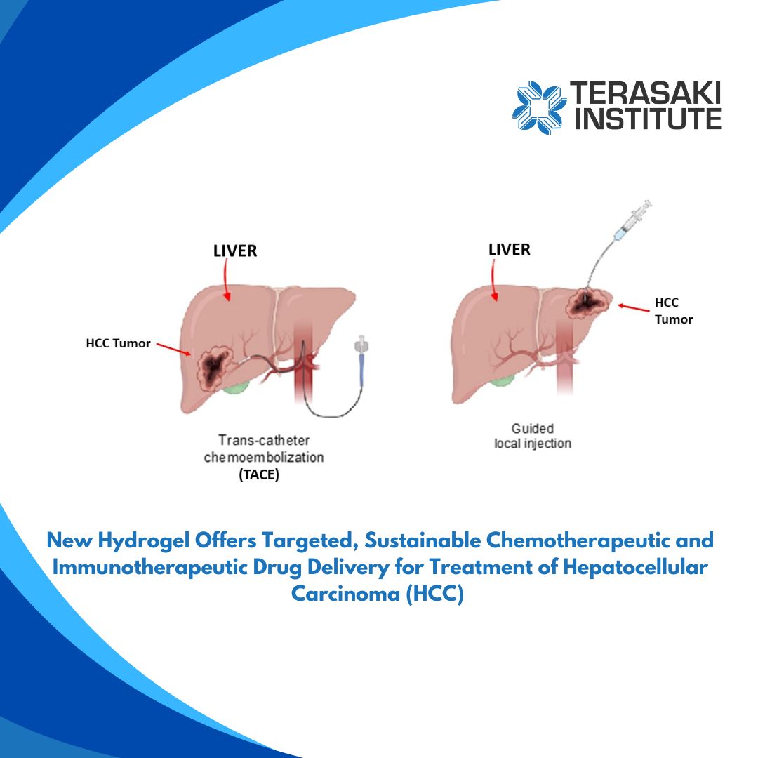 Scientists from the Terasaki Institute have developed an injectable or catheter-administered hydrogel with enhanced capabilities for treating hepatocellular carcinoma (HCC), a deadly form of liver cancer.  
buff.ly/48aNeVE 

#TerasakiInstitute  #HepatoCellularCarcinoma