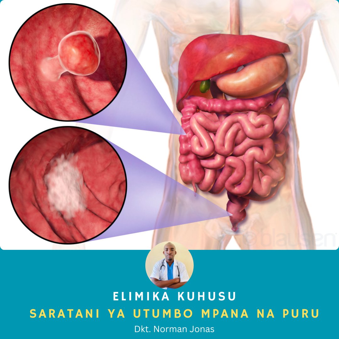 NormanJonasMD's tweet photo. SARATANI YA UTUMBO MPANA NA PURU ( COLORECTAL CANCER)

Hii ni aina ya saratani ambayo kesi zake zinaongezeka.

Kwa sasa tunapoteza hata vijana chini ya miaka 40.

Sababu ni nini? 

Mbinu gani za kiafya tutumie kujilinda?

Elimu msingi kuhusu saratani hii (soma chini) 👇