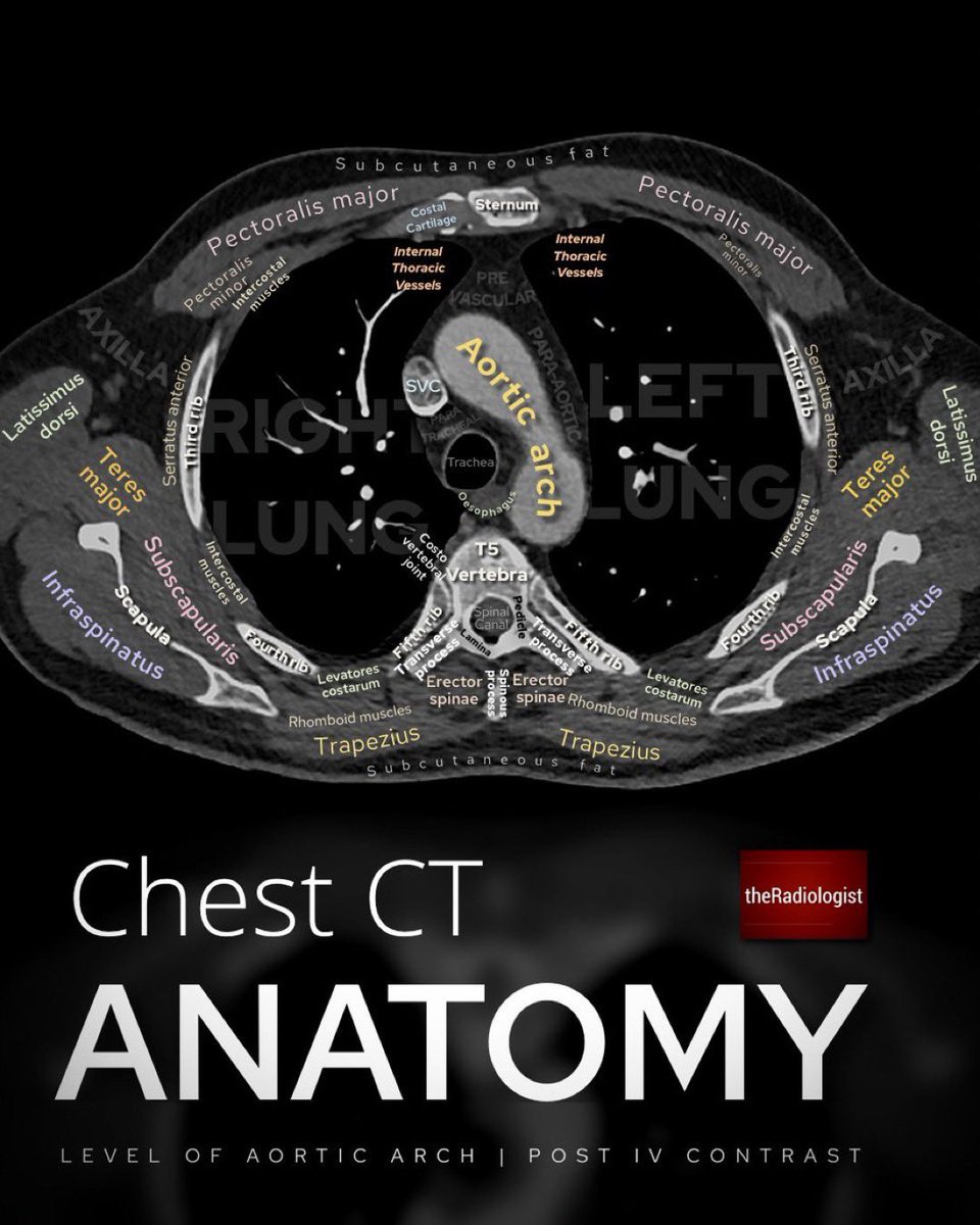 Junior #radres - axial CT anatomy at level of aortic arch 🫁 From @radiologistpage #chestrad