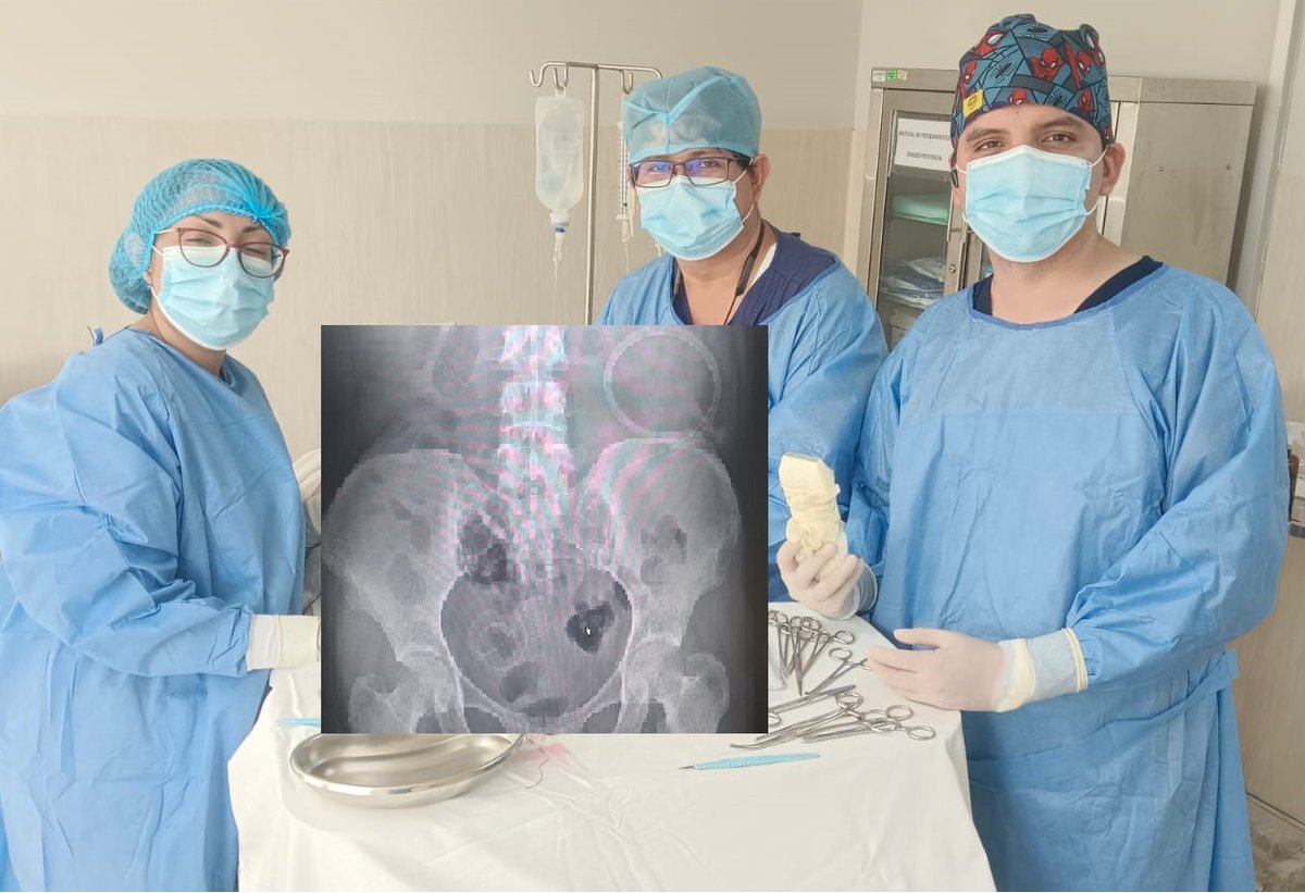 lluncornefro's tweet image. Implante de catéter peritoneal para Diálisis Peritoneal como primera opción.
Servicio Nefrologia - @H2deMayo 🇵🇪
Con nuestros R3 y R1
#PDFirst #InterventionalNephrology
#YoSoySLANHJoven