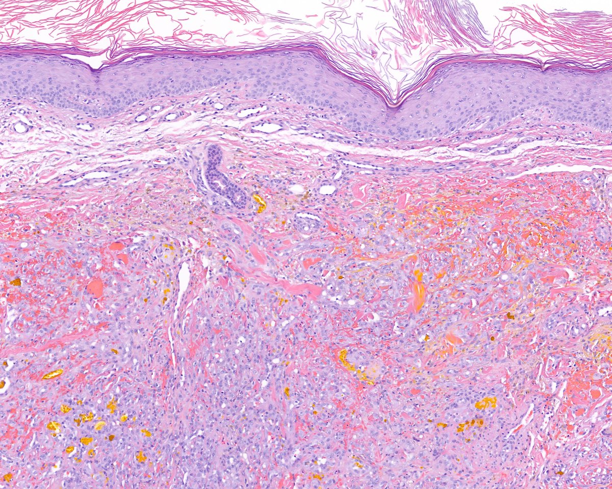 Gold medalist (truly) at the Recanalizing Hemangioma World Championships. Hematoidin division.