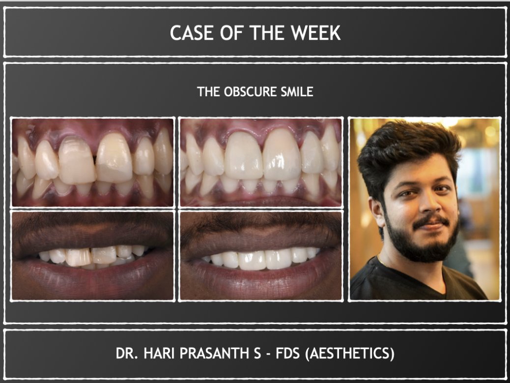 Case of the week - The Obscure Smile #dentistry #aesthetics #DentalCare #DentalHealth