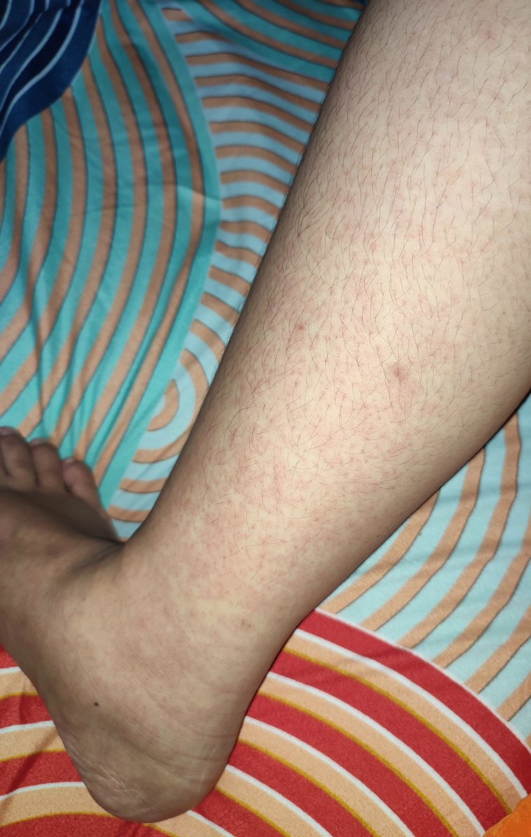 ImgonnaFine's tweet photo. @ohmybeautybank Aku beli di tntbeauty gatau ori atau palsu, yang jelas ga cocok, ampe seluruh badanku merah kayak alergi apalagi muka, nangis aja itu https://t.co/puqneBY6Ey