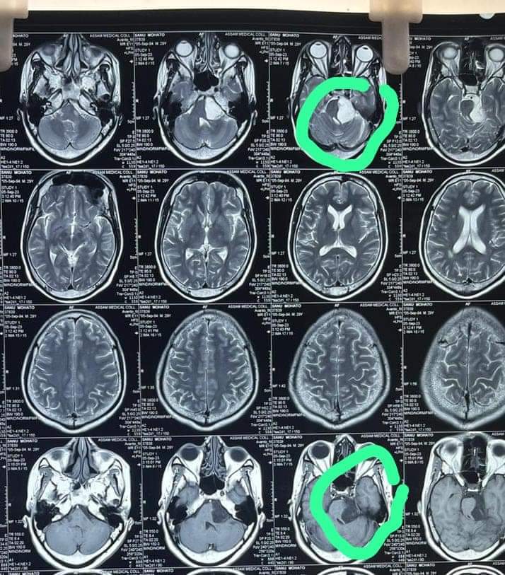 keshab_mahanta's tweet photo. Congratulations to the Neurosurgeons team at @AMCHDibrugarh for  successfully performing Neuroendoscopy on a patient and removing the brain tumour. Wishing the patient a speedy recovery.

The team of surgery was led by Prof. (Dr) B.K. Baishya, senior Neurosurgeon, Director of CN Centre, @gmchgauhati , Dr Dhruba Jyoti Kurmi, Dr Pratosh Paul, Dr Nayanjeet Deka and Dr Chintu Patowary. The Anesthesiology team was led by Prof. Dr Diganta Saikia, Dr R.P. Tayung and Dr Rini. Nursing staff was led by Ms. Rina Lawriniang and Mrs Padmini Gohain. The OT assistant was led by Mr Pranjal Saikia.