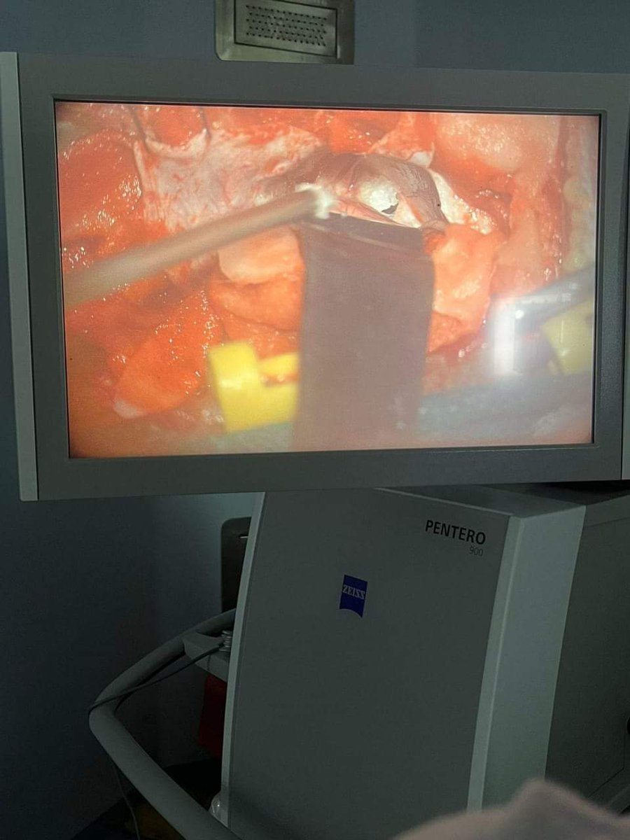keshab_mahanta's tweet photo. Congratulations to the Neurosurgeons team at @AMCHDibrugarh for  successfully performing Neuroendoscopy on a patient and removing the brain tumour. Wishing the patient a speedy recovery.

The team of surgery was led by Prof. (Dr) B.K. Baishya, senior Neurosurgeon, Director of CN Centre, @gmchgauhati , Dr Dhruba Jyoti Kurmi, Dr Pratosh Paul, Dr Nayanjeet Deka and Dr Chintu Patowary. The Anesthesiology team was led by Prof. Dr Diganta Saikia, Dr R.P. Tayung and Dr Rini. Nursing staff was led by Ms. Rina Lawriniang and Mrs Padmini Gohain. The OT assistant was led by Mr Pranjal Saikia.