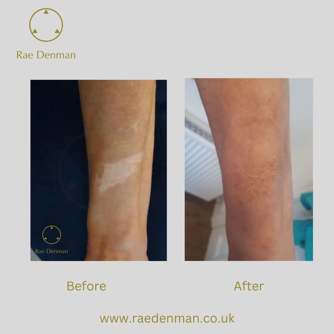 Do you have an area with a lack of #pigment / #hypo-pigmentation? Taking a step to address your #visibledifference can have a profound positive affect on your confidence.

For this reason, #medicaltattooing is a step worth taking.

buff.ly/38K4P92
#medicaltattooinglondon