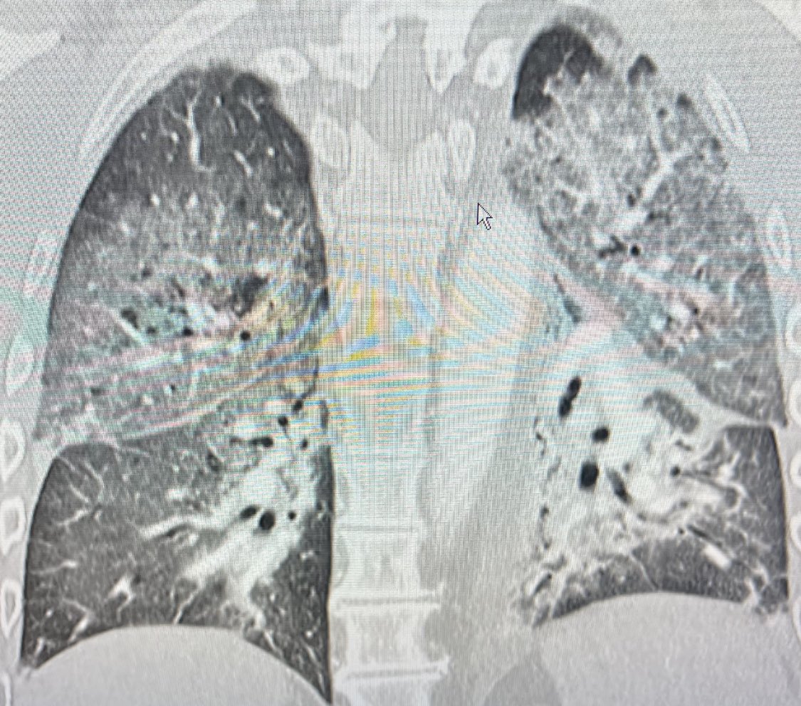Als ich das CT sah, habe ich zunächst zwei Dinge gecheckt:
Ein Labortest und eine Frage anamnestisch an den Patienten.
Welche?